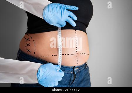 Loose Waist Care By Doctor In Clinic. Liposuction Surgery Stock Photo