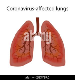 Human lungs damaged by coronavirus covid-19. The concept of the stage of damage to the respiratory tract virus. Isolated vector EPS10. Stock Vector