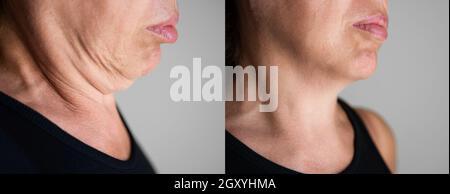 Double Chin Face Injection And Plastic Surgery Stock Photo