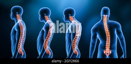 X-ray Spinal Column With Scoliosis, Lordosis And Kyphosis Postures ...