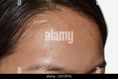 Oily skin and pimples on wide forehead of Southeast Asian, Myanmar or Korean adult young woman. Stock Photo