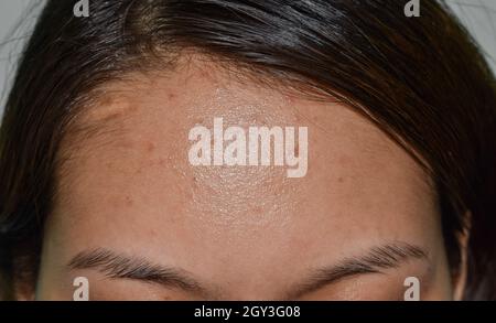 Oily skin and pimples on wide forehead of Southeast Asian, Myanmar or Korean adult young woman. Stock Photo