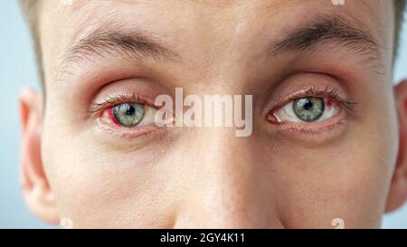 young man with red eyes looking at the camera Stock Photo