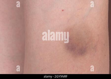 Big hematoma, bruise on woman leg, pain concept closeup. Stock Photo