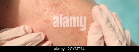 Doctor in rubber gloves examining skin of patient with red rash in clinic closeup Stock Photo