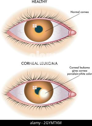 Medical illustration shows the comparison between a normal eye and one affected by corneal leukoma. Stock Vector