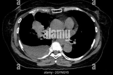 Lung cancer, CT scan Stock Photo