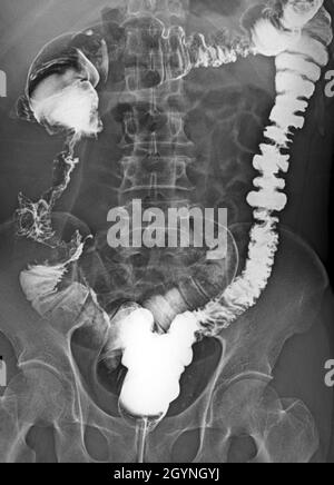 Colorectal cancer, X-ray Stock Photo