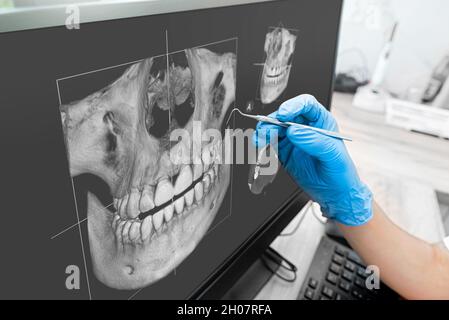 Doctor looking at human teeth x-ray on computer monitor. Modern dental clinic. Stock Photo