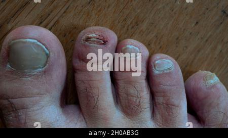 Foot with a injured toe. Long toe has a detached toenail. Foot has not been taken care of. Stock Photo