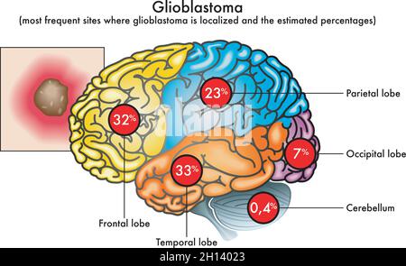 Medical illustration of most frequent sites where glioblastoma is localized in the brain and the estimated percentages. Stock Vector