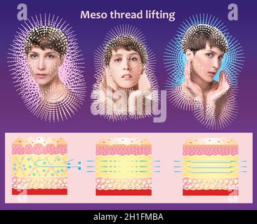 Meso thread Lift. Young female with clean fresh skin. Beautiful woman. face and neck. Lifting by threads concept Stock Photo