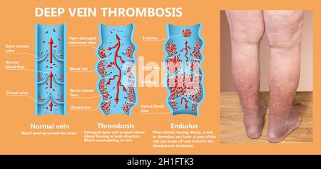 thrombosis. From Normal blood flow to Blood clot formation Stock Photo ...