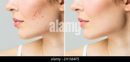 Young woman before and after acne treatment. Skin care concept Stock Photo