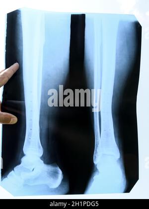 Fused bones of the lower leg after removing the steel bonding plate, x-ray of the leg Stock Photo
