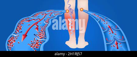 Varicose vein on a female senior legs. The structure of normal and varicose  veins. Concept of dry skin, old senior people and deep vein thrombosis or  Stock Photo - Alamy