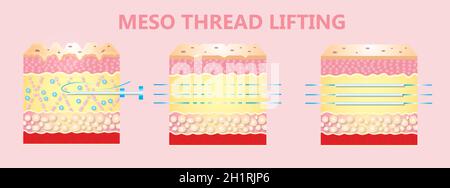 Meso thread Lift. Young and old skin. Lifting by threads concept. Vector Illustration Stock Photo
