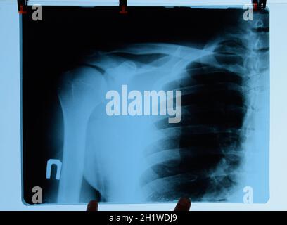 X-ray of shoulder and clavicle, X-ray picture of shoulder joint. Stock Photo