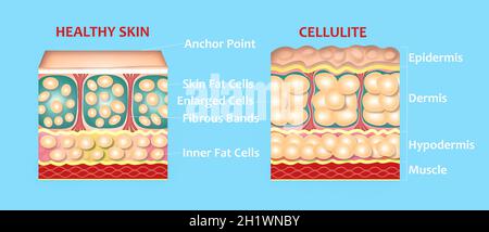 Forming of underskin cellulite illustration. Structure of normal healthy and cellulite skin. Comparison Stock Photo