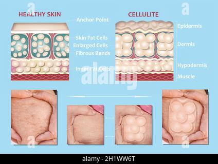 Forming of underskin cellulite illustration. Structure of normal healthy and cellulite skin. Comparison Stock Photo