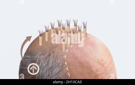 Methods of hair transplantation FUT and FUE fue with transplant as infographic element of illustration. Human alopecia or hair loss problem on adult s Stock Photo