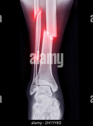 X-ray image of ankle joint showing fracture of ankle joint Stock Photo ...