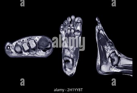 Manetic resonance imaging of foot or MRI FOOT PDW axial, Coronal and sagittal view for diagnostic tendon injury. Stock Photo