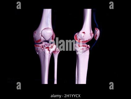 Compare of CT knee joint 3D rendering image lateral view and CT knee 2D ...