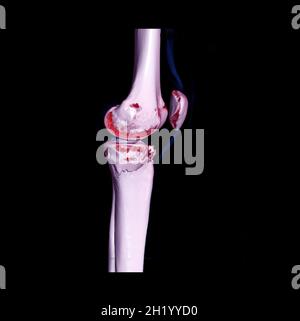 CT knee 3D rendering image isolated on black background for diagnosis ...