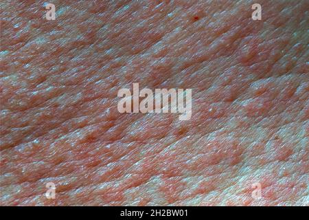 Skin texture painful in red blisters skin rashes after chemical burn Stock Photo