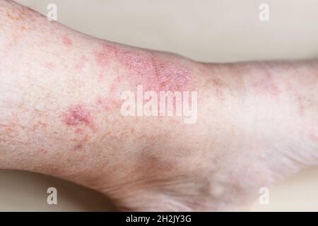 sample of Allergic contact dermatitis - eczema on male shin close up Stock Photo