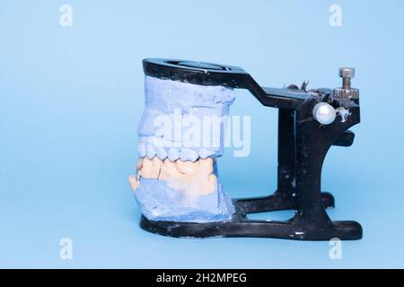 Tooth recovery with implant. Veneers and crowns on gypsum dental artificial jaw on blue background. Upper and lower jaws plaster model with prepared Stock Photo