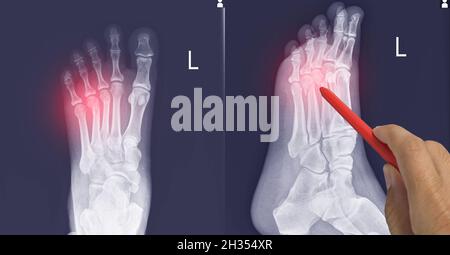 Close up X-ray Foot  AP-Lateral showing fracture 3th,4th metatarsal bone, Doctor holding a red pen point , symptoms medical healthcare concept. Stock Photo