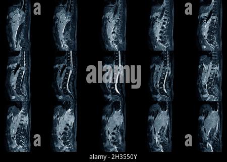 Lumbar spinal stenosis MRI scan Sagittal view finding moderate posterior inferior tumor protrusion cause bilateral root compression. Chronic low back Stock Photo