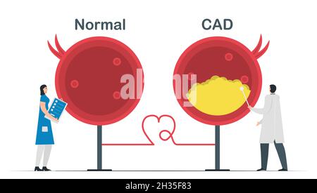 Comparison of Normal heart and Coronary artery disease.Cardiology vector illustration isolated on white background. Stock Vector