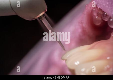 Closeup of laser etching teeth procedure for Direct Bonding of Orthodontic Appliance Stock Photo