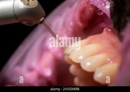 Closeup of laser etching teeth procedure for Direct Bonding of Orthodontic Appliance Stock Photo