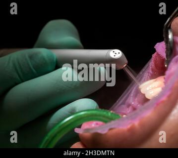 Closeup of laser etching teeth procedure for Direct Bonding of Orthodontic Appliance Stock Photo