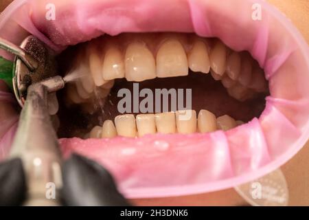 Closeup of teeth sandblasting, tartar cleaning and whitening Stock Photo