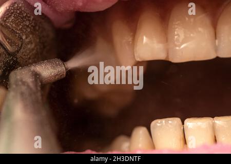 Closeup of teeth sandblasting, tartar cleaning and whitening Stock Photo