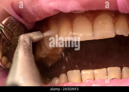 Closeup of teeth sandblasting, tartar cleaning and whitening Stock Photo