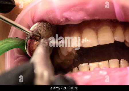 Closeup of teeth sandblasting, tartar cleaning and whitening Stock Photo