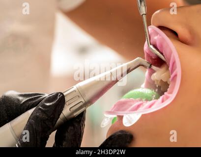 Closeup of teeth sandblasting, tartar cleaning and whitening Stock Photo