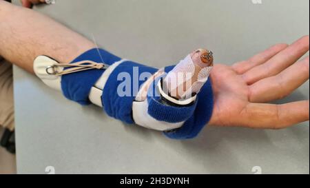 hand with splint after cut of the flexor tendon of the thumb Stock Photo