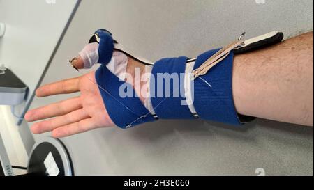 hand with splint after cut of the flexor tendon of the thumb Stock Photo