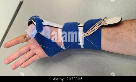 hand with splint after cut of the flexor tendon of the thumb Stock Photo