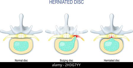 Spinal disc herniation. Difference Between Bulging disc and Herniated Disc. Vector illustration Stock Vector