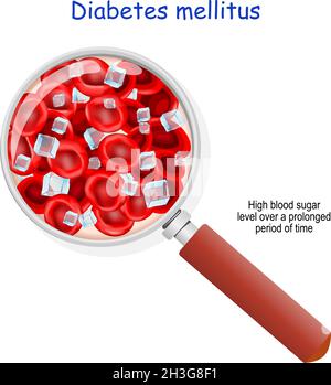 Diabetes mellitus. High blood sugar level over a prolonged period of time. magnifying glass. Close-up of blood flow with red blood cells and glucose Stock Vector