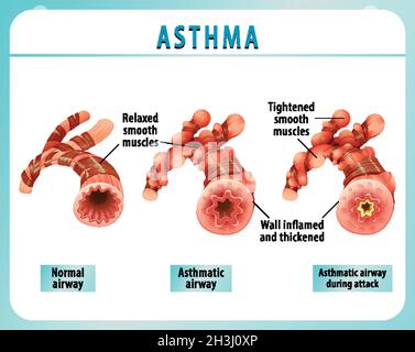 Asthma Diagram With Normal Airway And Asthmatic Airway Illustration 