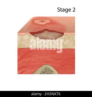 Stage 2 pressure sore, illustration Stock Photo